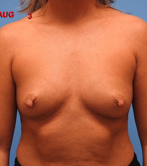 Breast Augmentation (Silicone)