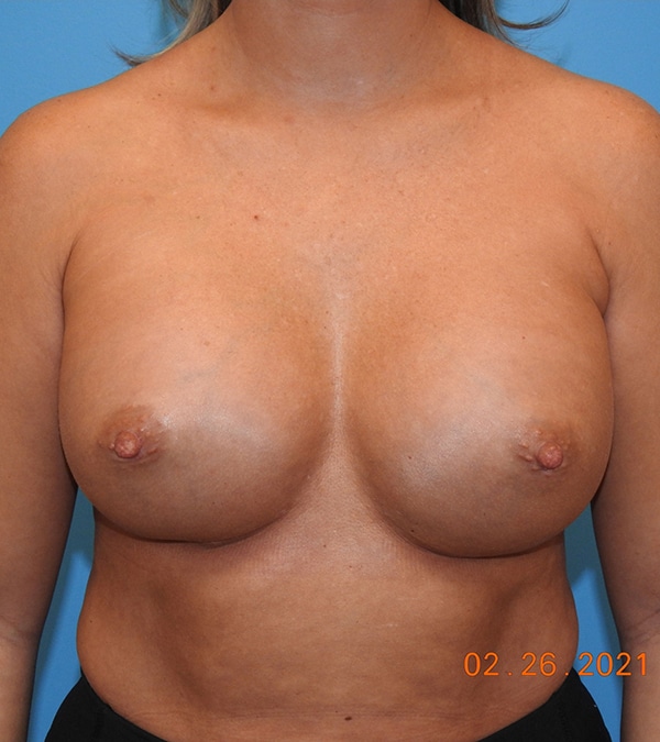 Breast Augmentation (Silicone)
