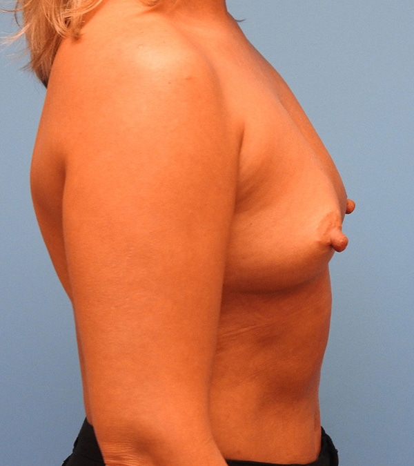 Breast Augmentation (Silicone)