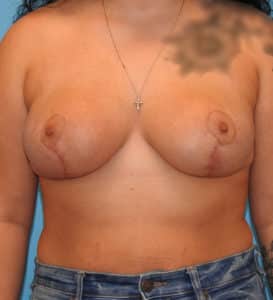 Breast Reduction