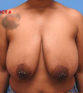 Breast Reduction