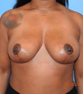 Breast Reduction