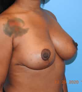 Breast Reduction