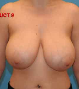 Breast Reduction
