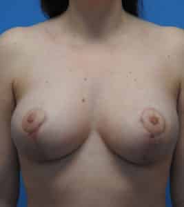 Breast Reduction