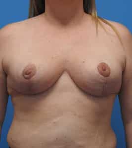 Breast Reduction