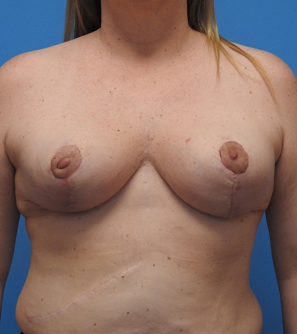 Breast Reduction