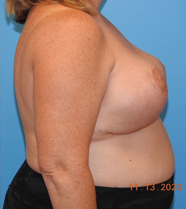 Breast Reduction
