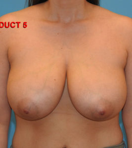 Breast Reduction