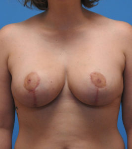 Breast Reduction