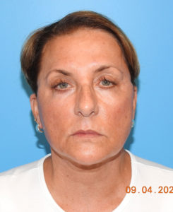 Facelift
