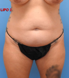 Liposuction