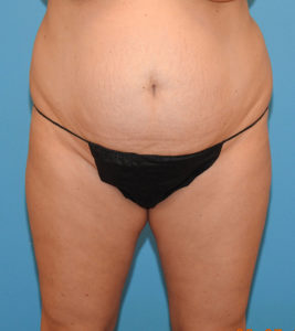 Liposuction