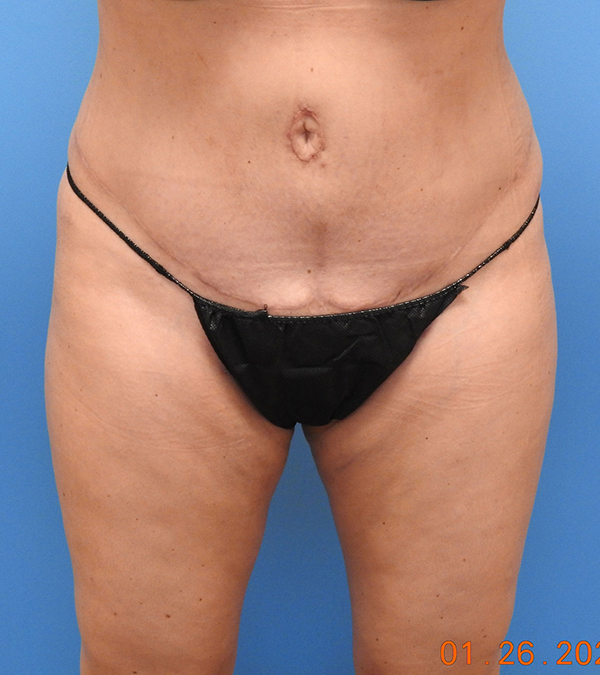 Liposuction