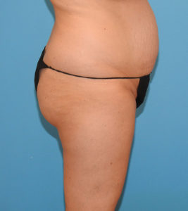 Liposuction