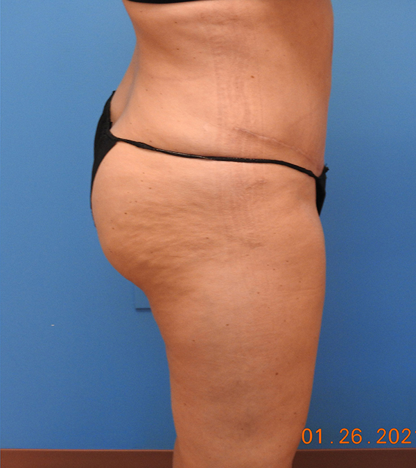 Liposuction