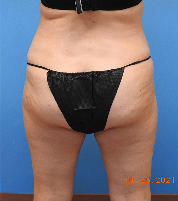 Liposuction