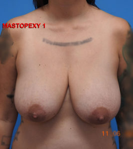 Breast Lift/Mastopexy