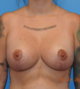 Breast Lift/Mastopexy