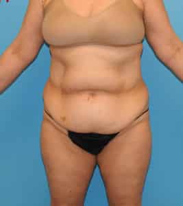 Tummy Tuck