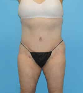 Tummy Tuck