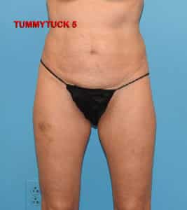 Tummy Tuck