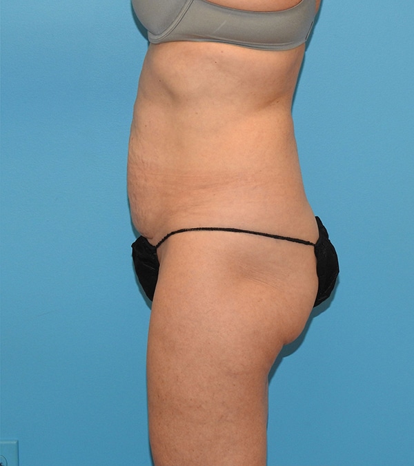 Tummy Tuck
