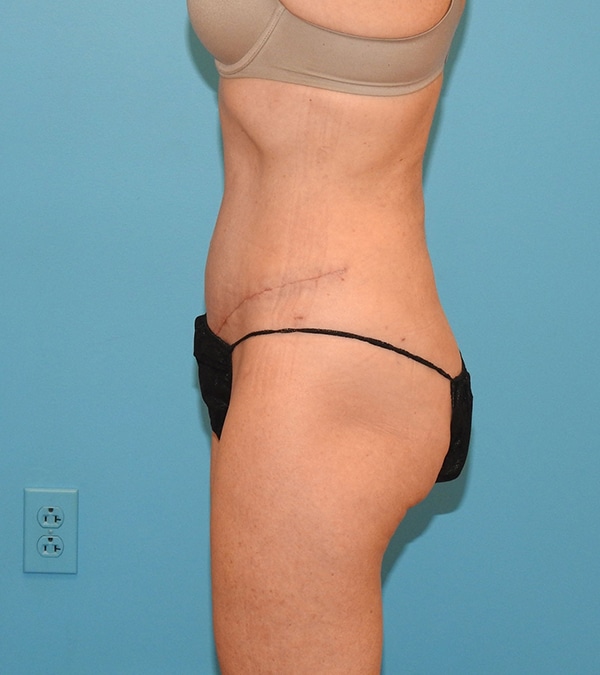 Tummy Tuck