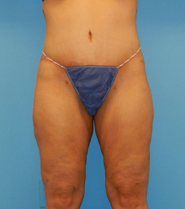 Tummy Tuck