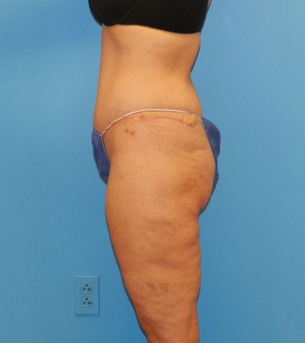Tummy Tuck