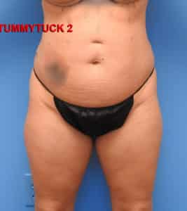 Tummy Tuck