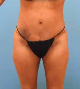 Tummy Tuck