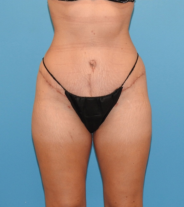 Tummy Tuck