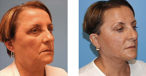 Facelift Before and After Photos Pittsburgh and Pennsylvania