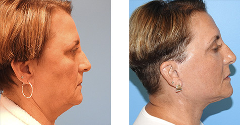 Facelift Before and After Photos Pittsburgh and Pennsylvania