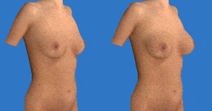 breast-aug-animation-bna-300x157-1