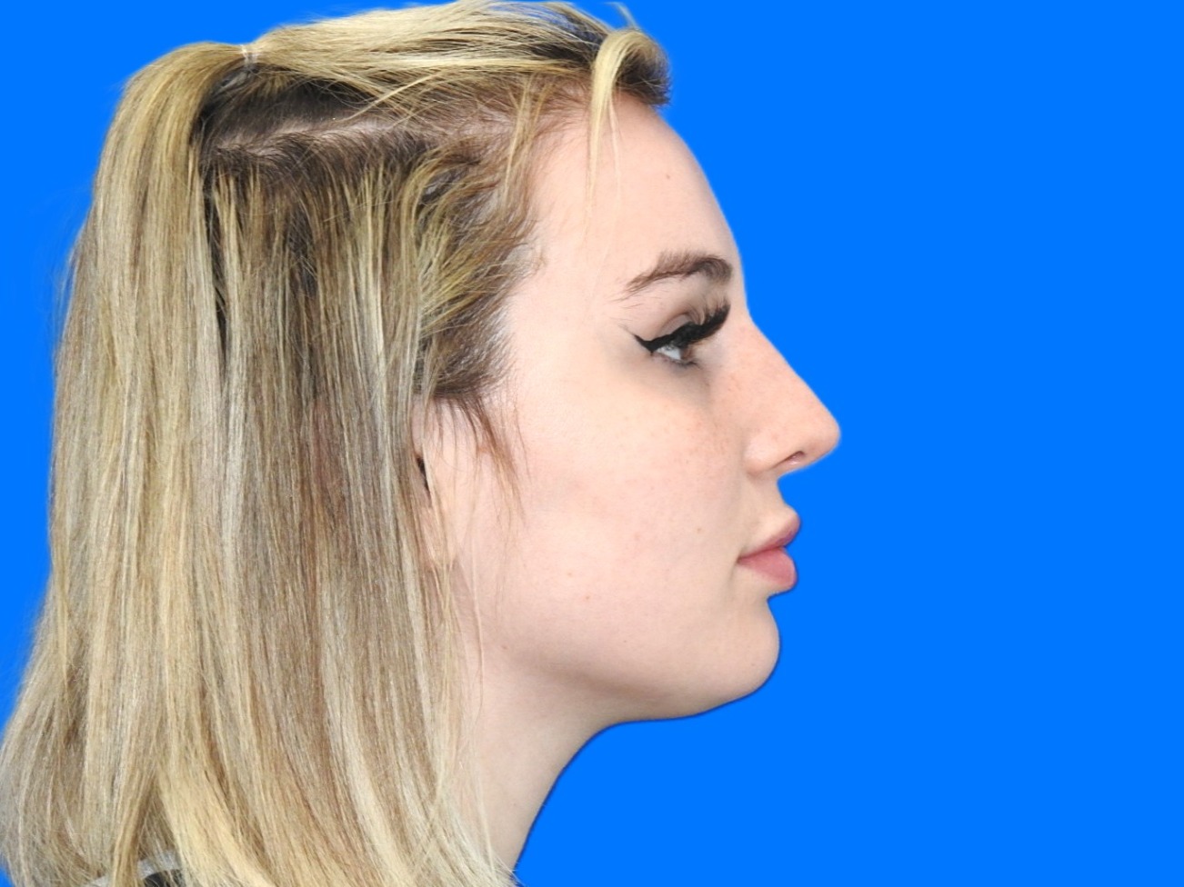 After Image: Patient Case #0100 - right-side