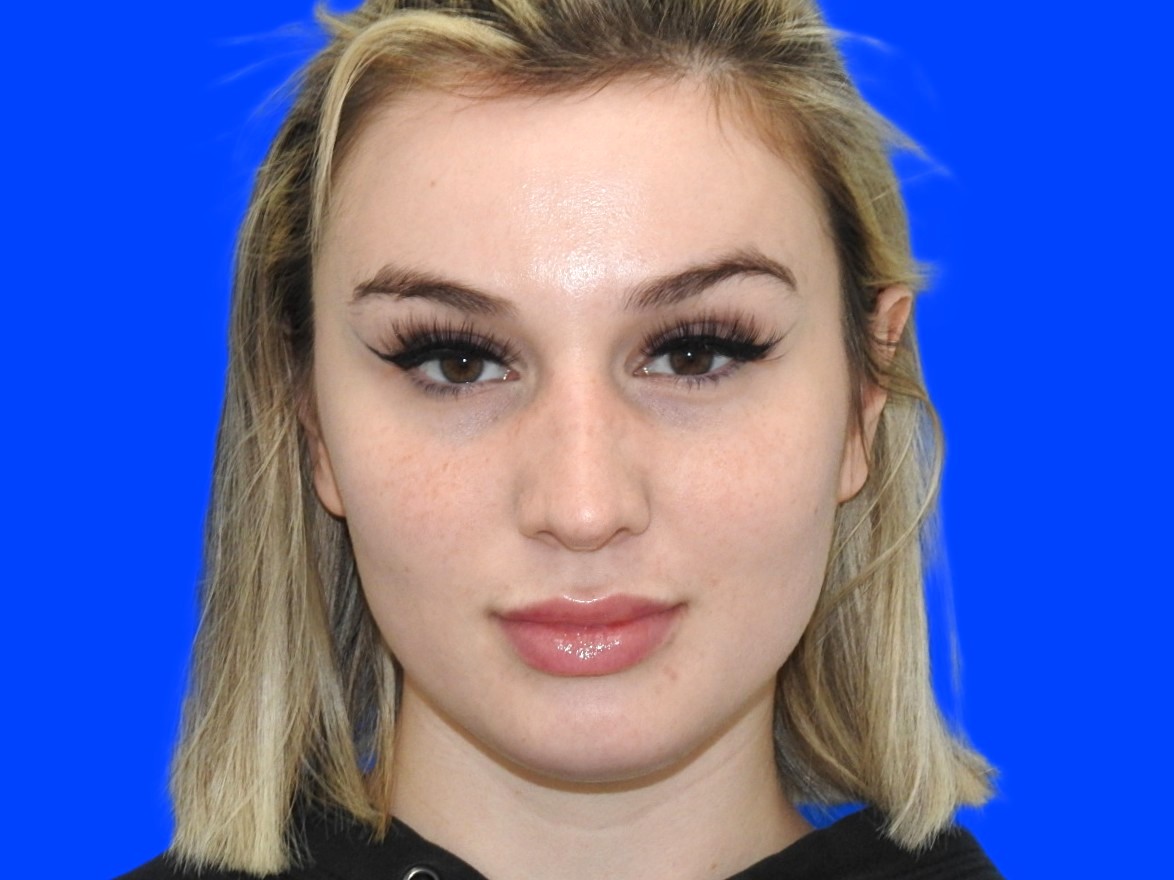 After Image: Patient Case #0100 - front