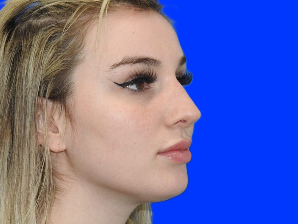 After Image: Patient Case #0100 - right-front-oblique