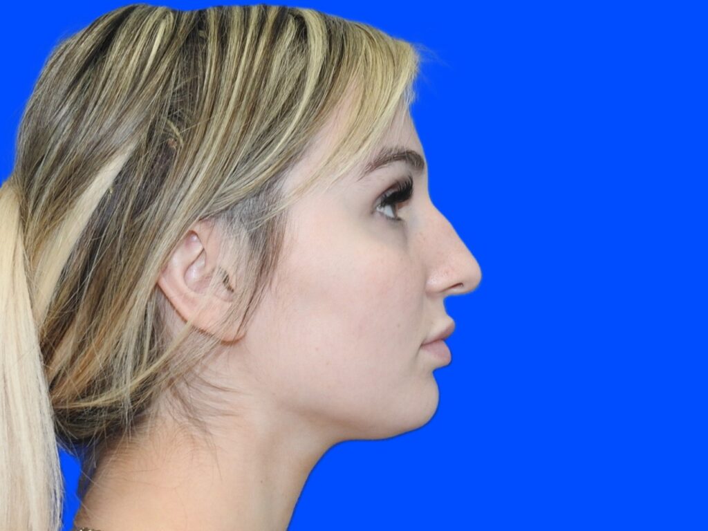 Before Image: Patient Case #0100 - right-side