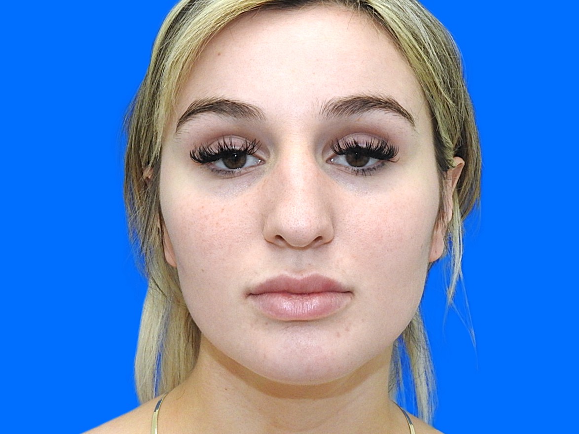 Before Image: Patient Case #0100 - front