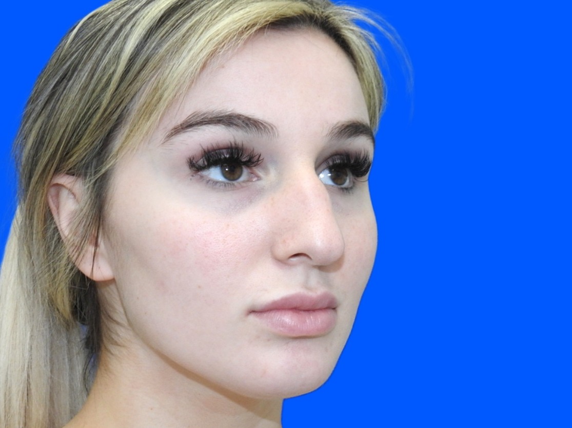 Before Image: Patient Case #0100 - right-front-oblique