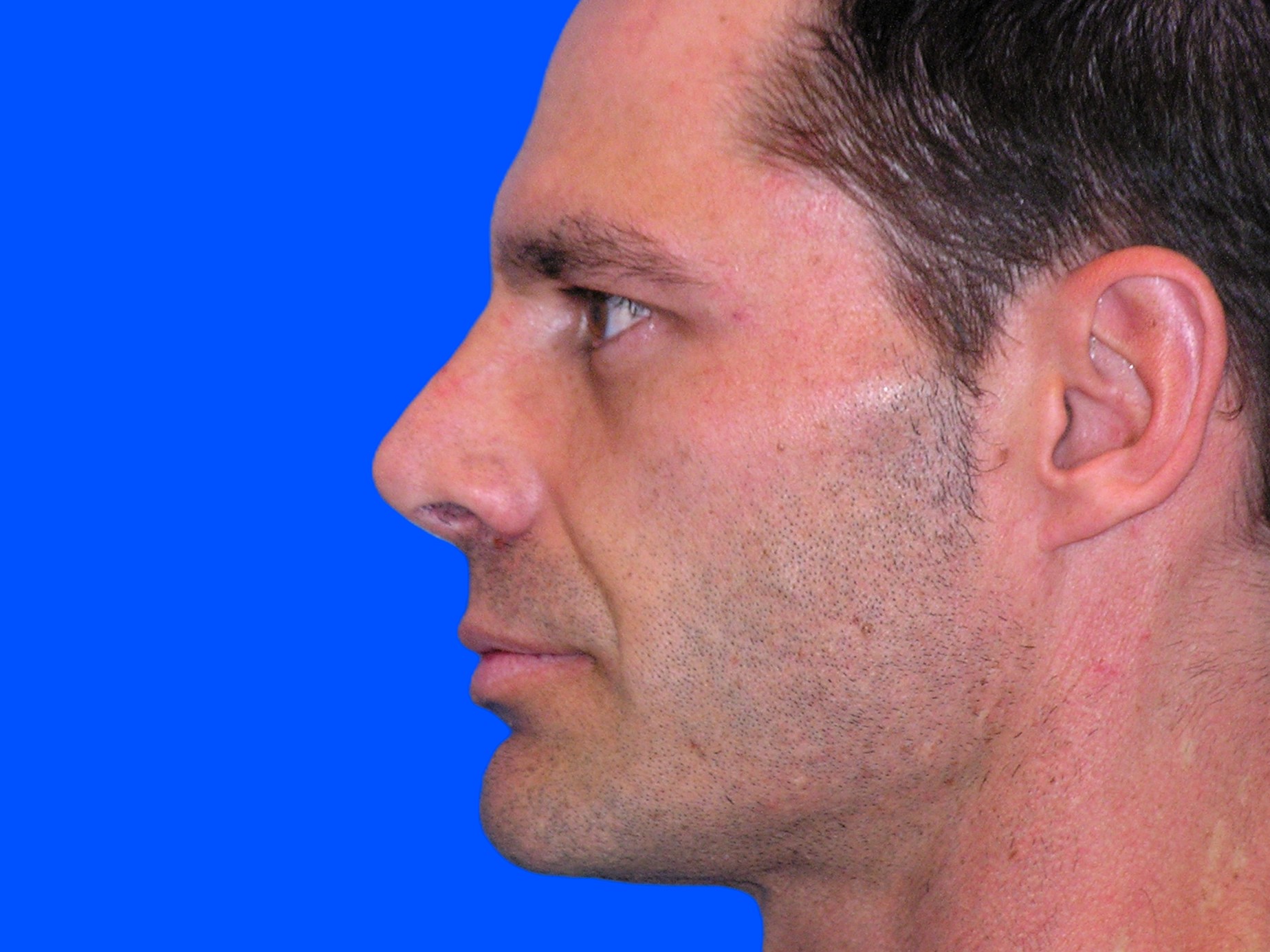 After Image: Patient Case #0101 - left-side