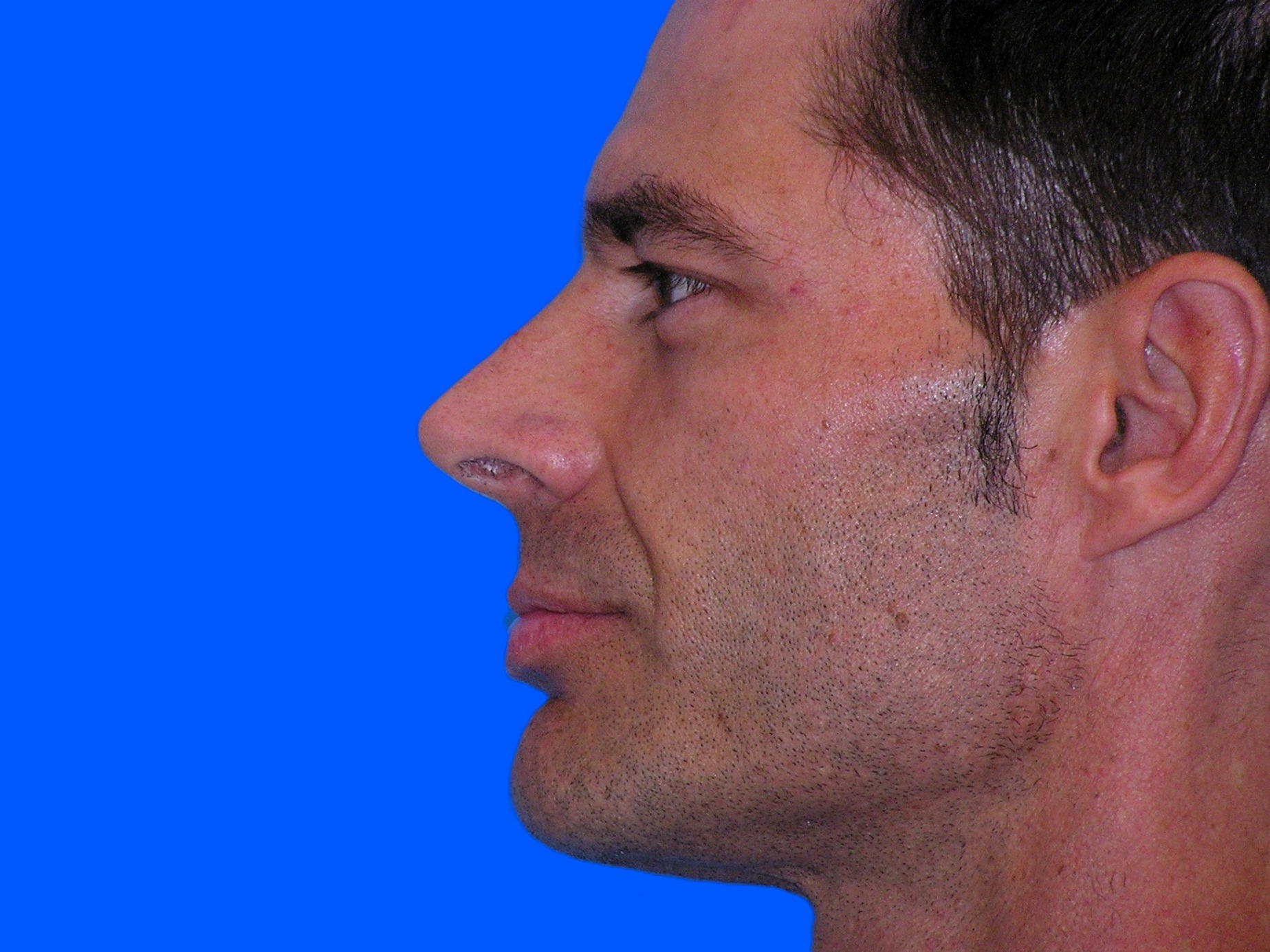 Before Image: Patient Case #0101 - left-side