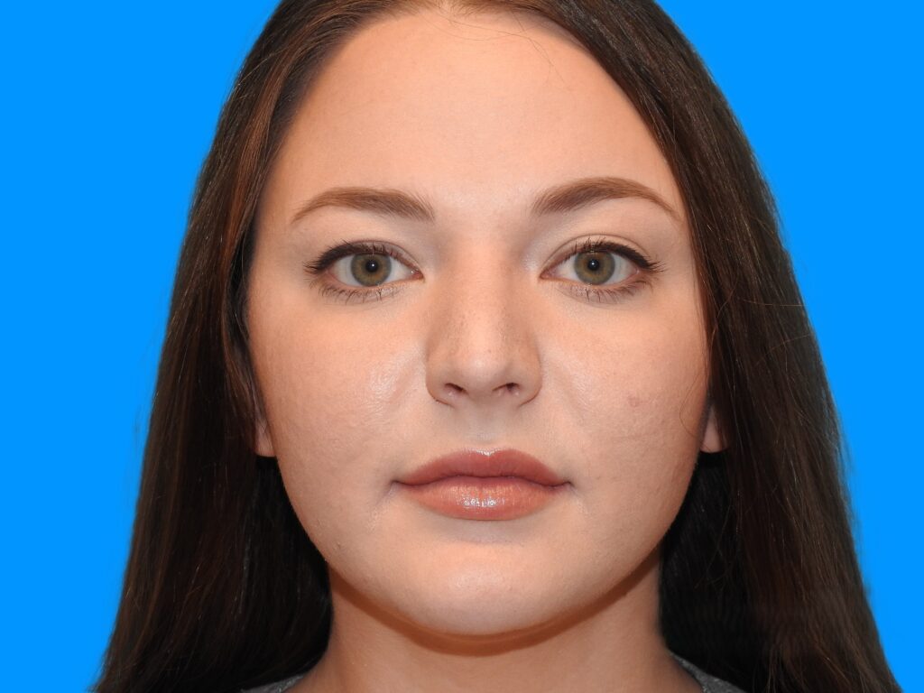 After Image: Patient Case #0102 - front