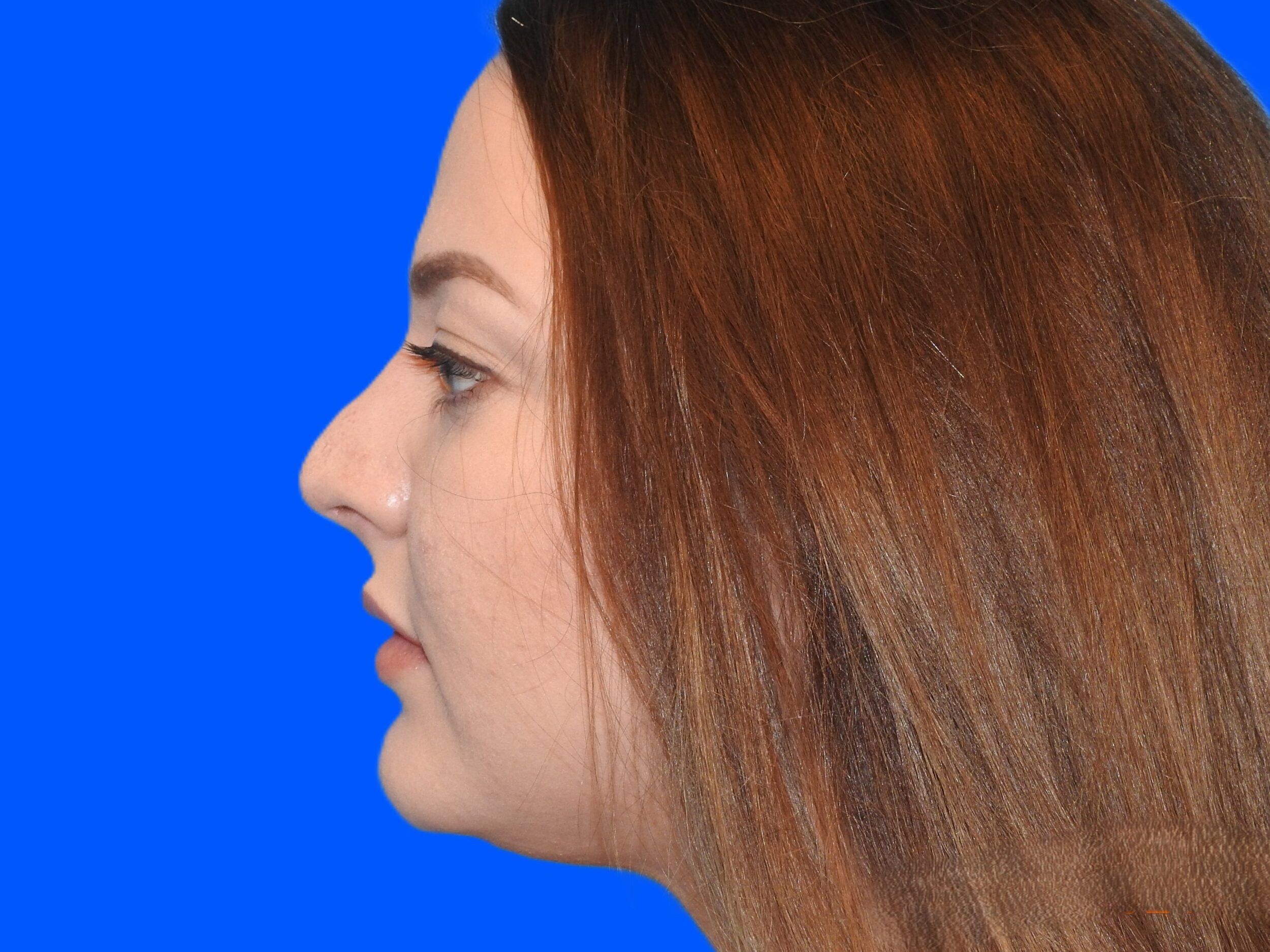 After Image: Patient Case #0102 - left-side