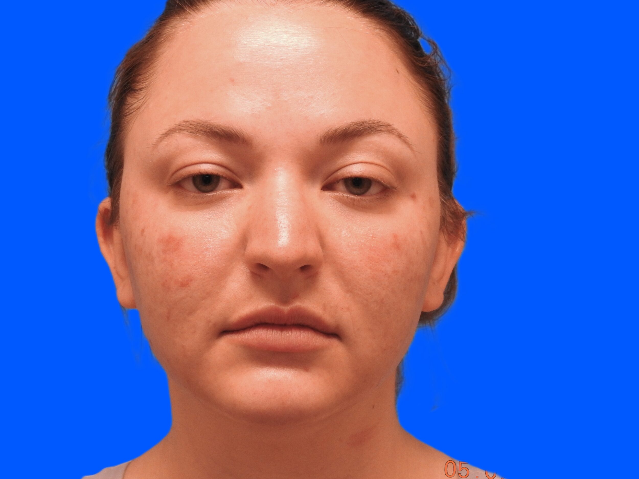 Before Image: Patient Case #0102 - front