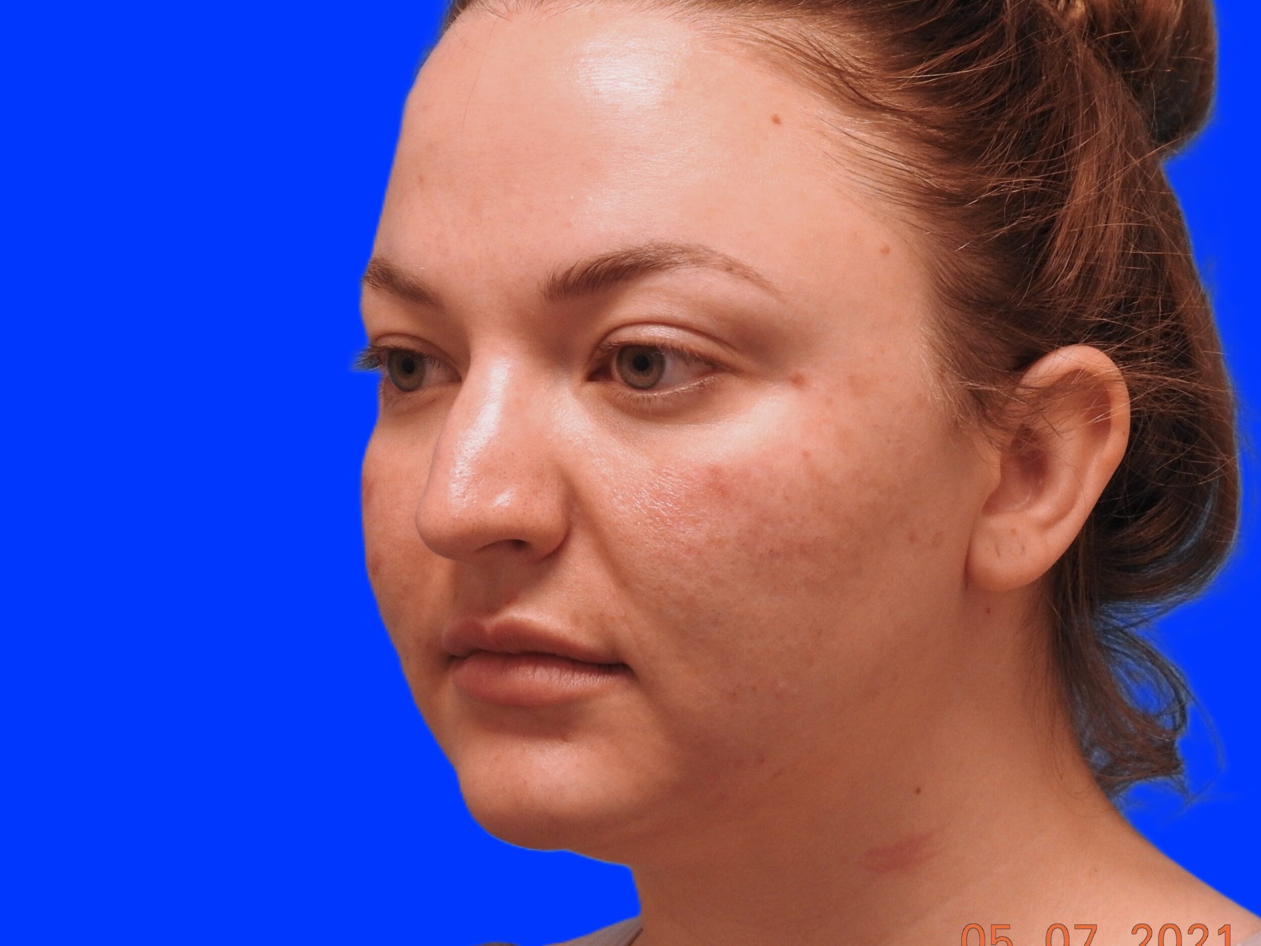 Before Image: Patient Case #0102 - left-front-oblique
