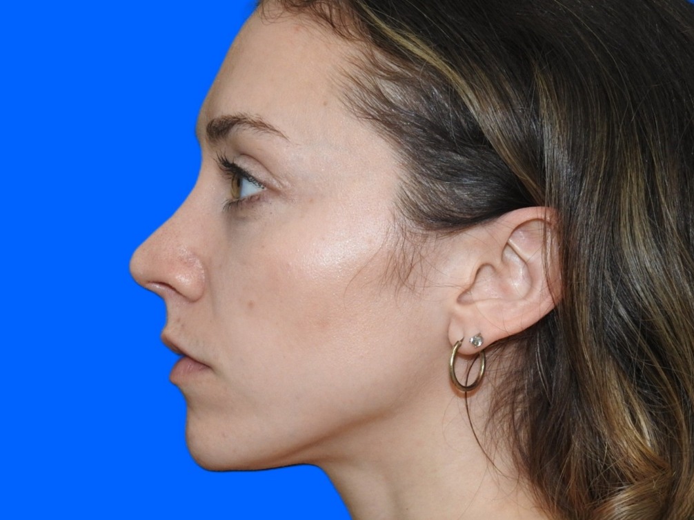 After Image: Patient Case #0103 - left-side