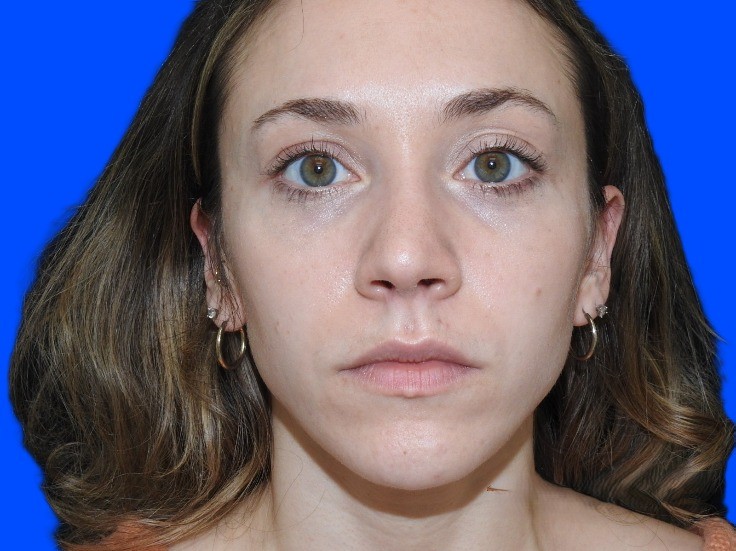 After Image: Patient Case #0103 - front